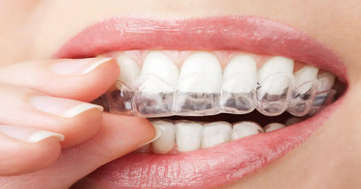 Invisalign
